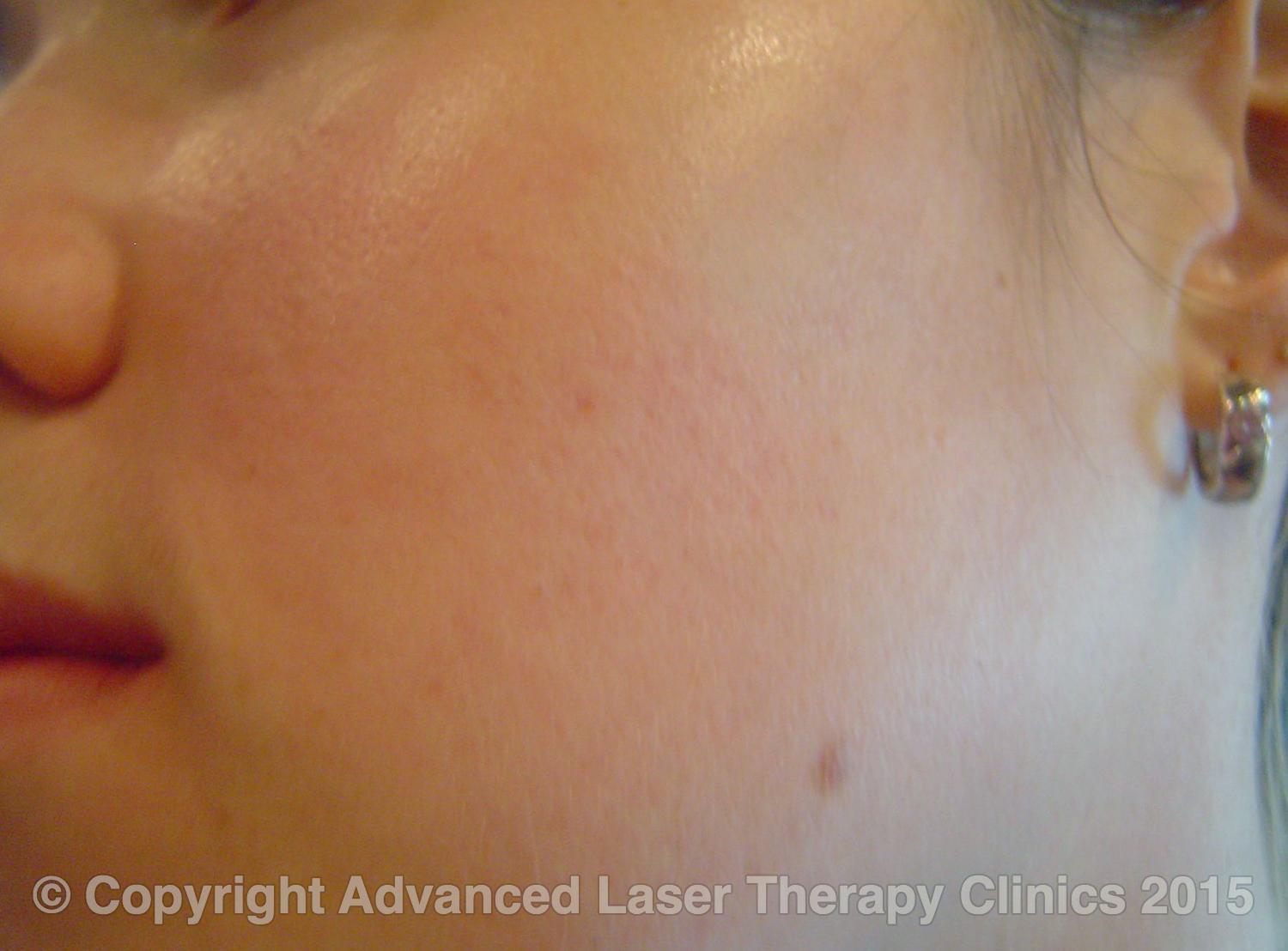 Acne, before and after treatment — After
