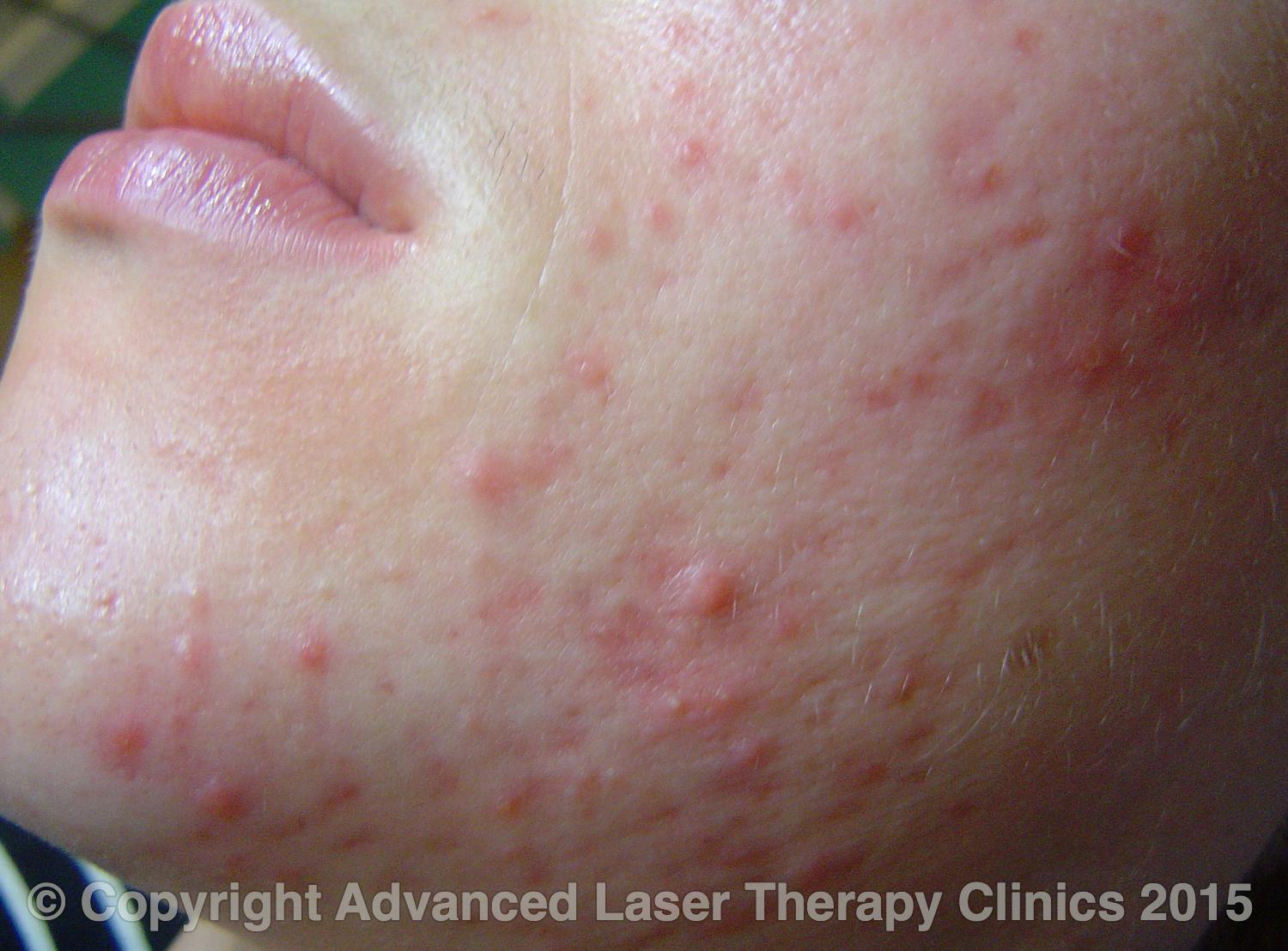 Acne, before and after treatment — Before