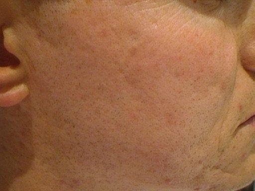 Acne scarring, after a series of herbal peels — After