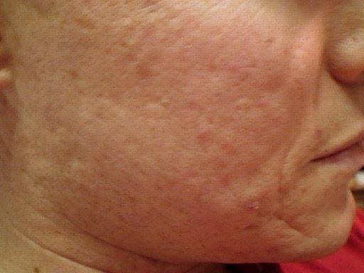 Acne scarring, after a series of herbal peels — Before