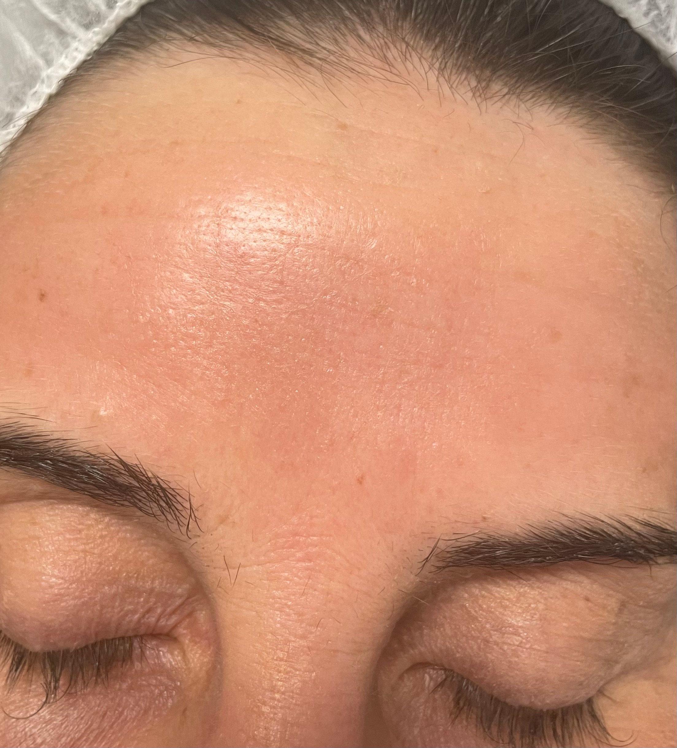 Face, laser rejuvenation — After