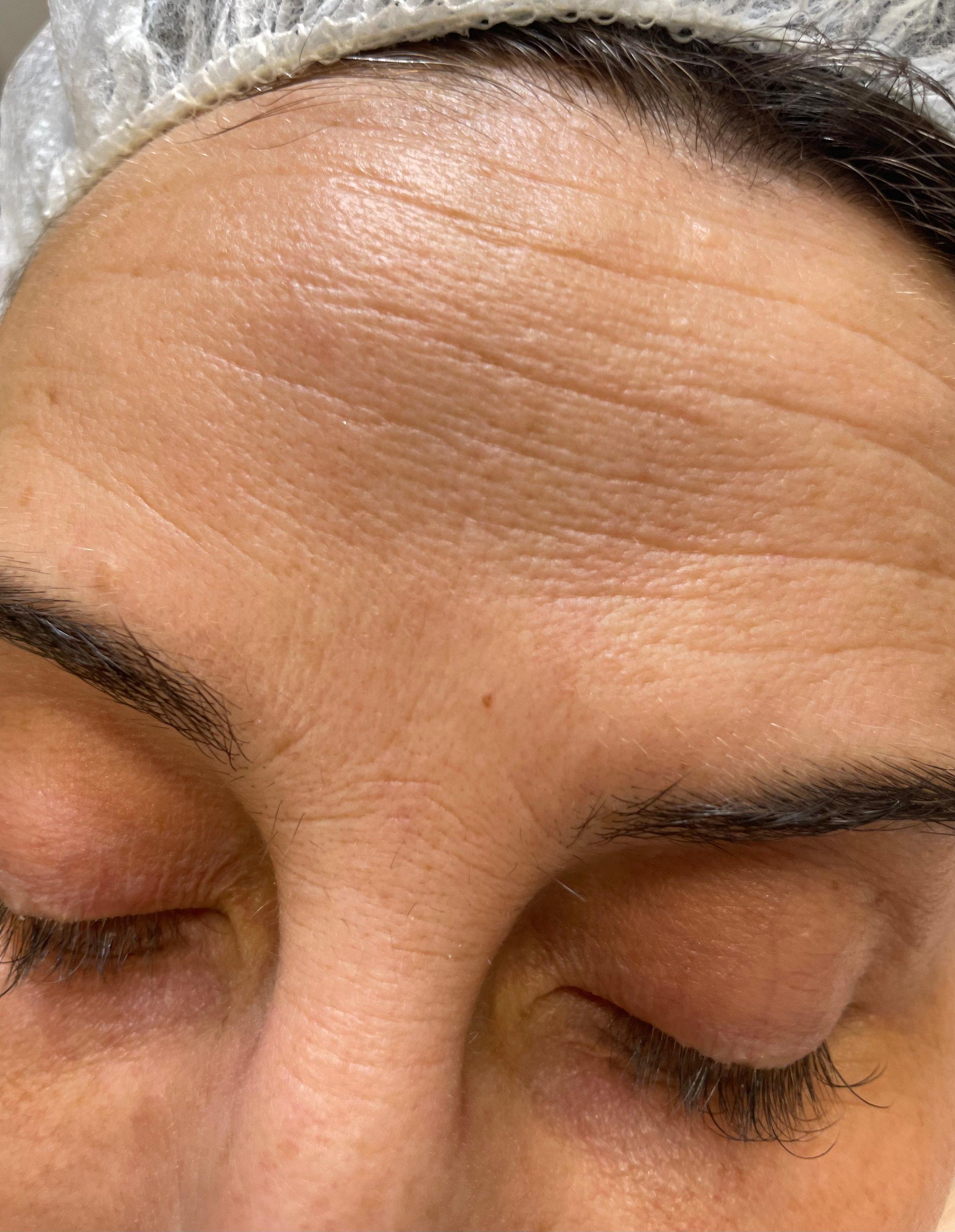 Face, laser rejuvenation — Before