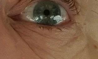 Mole removal — After