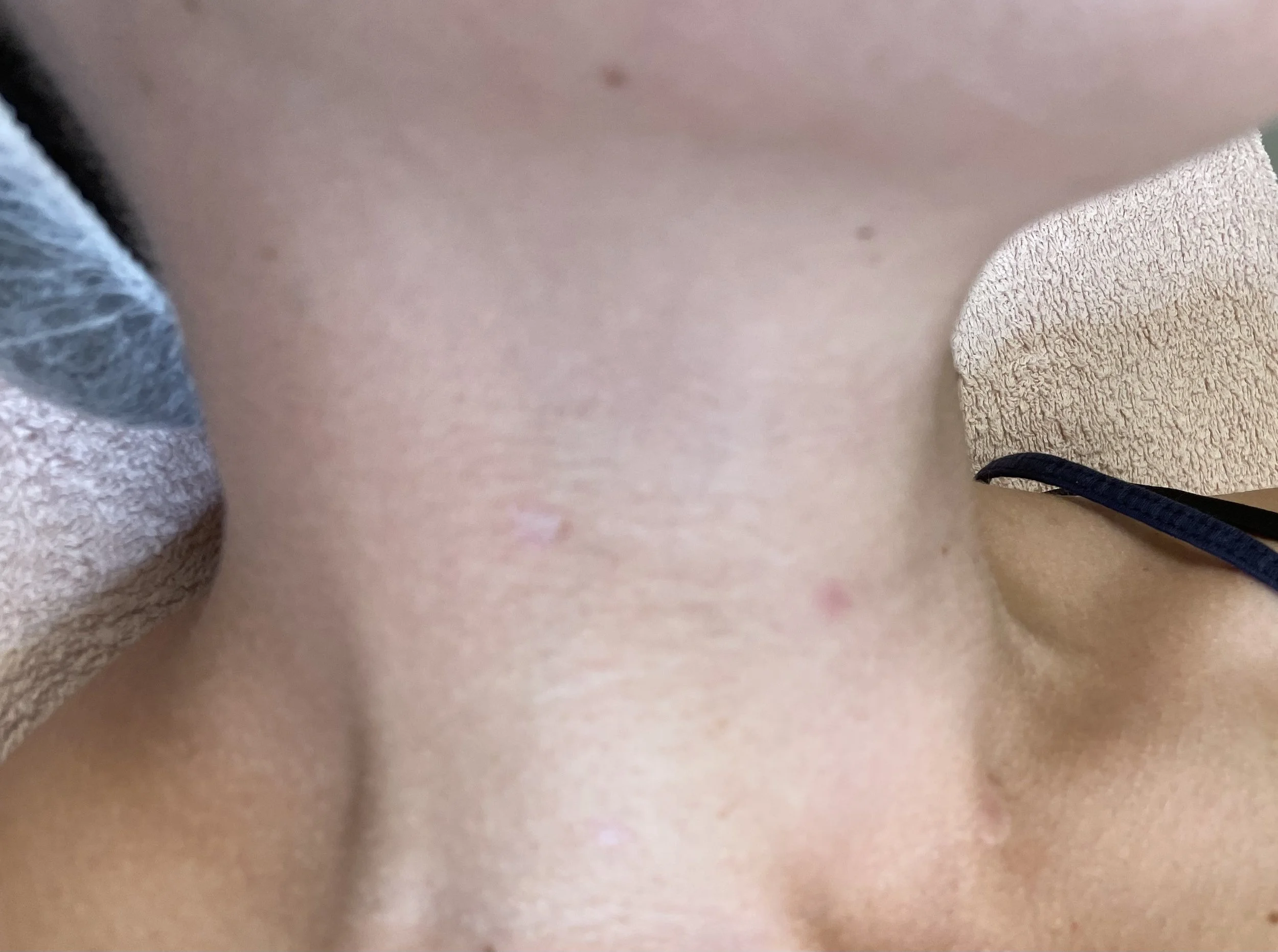 Mole removal, face — After