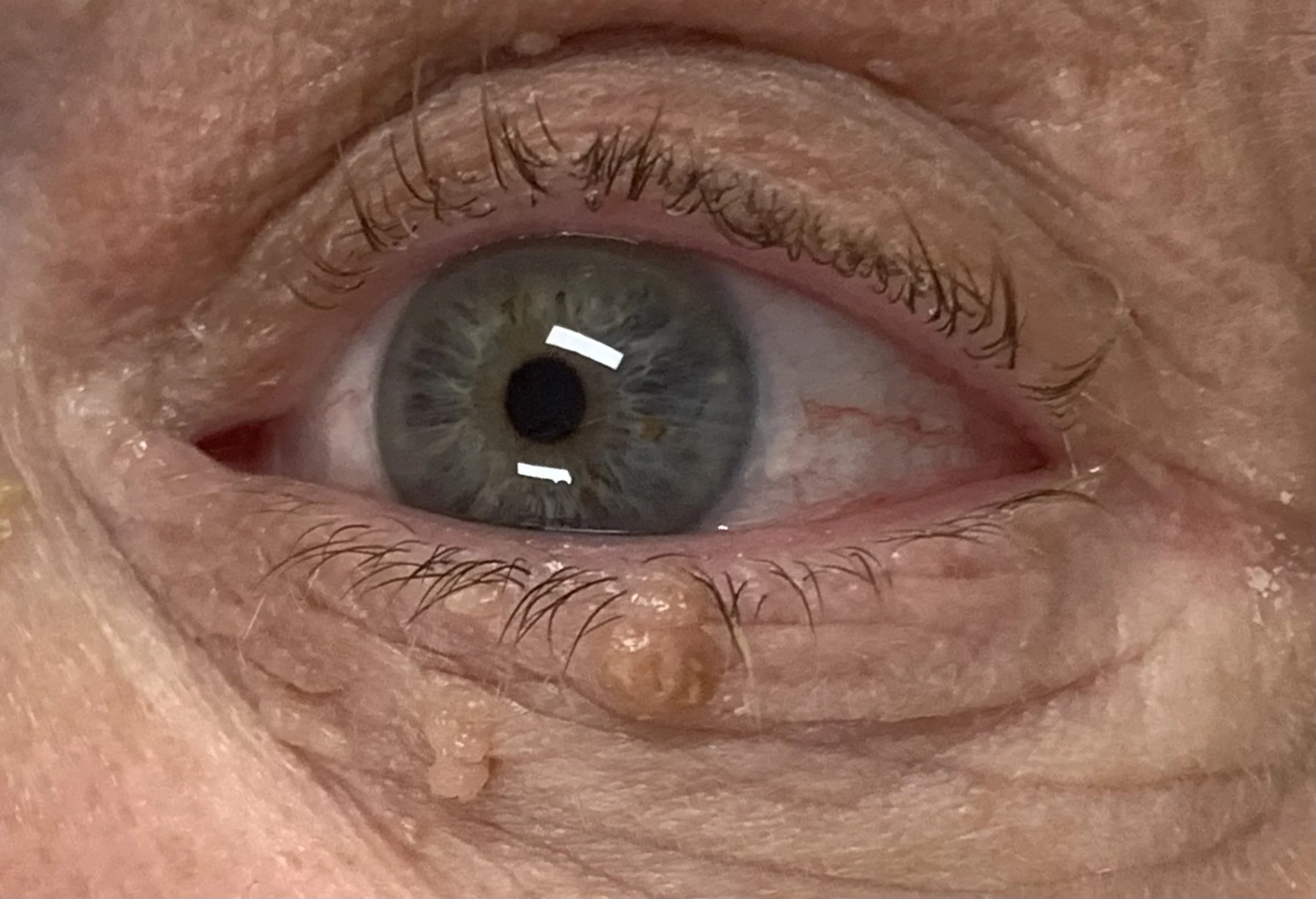 Mole removal — Before