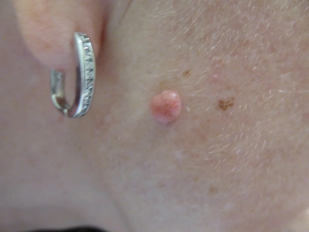 Raised lesion removal — Before