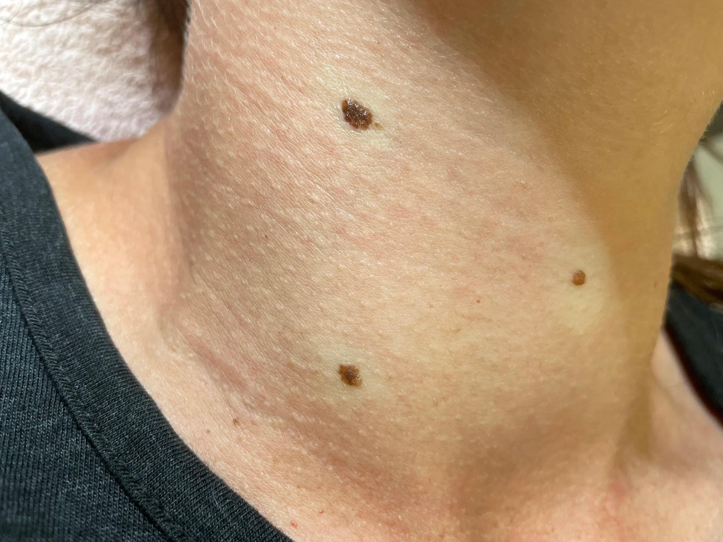 Mole removal, face — Before